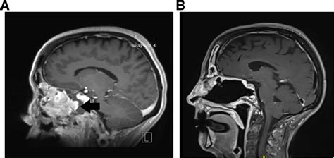 Mri Imaging Of The Olfactory Neuroblastoma Pre A And Post B