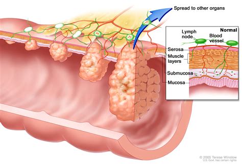 Understanding Colorectal Cancer Knight Cancer Institute Ohsu