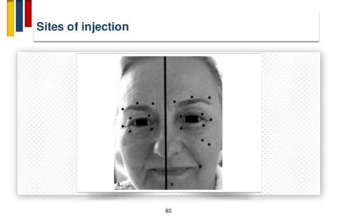 Botox For Hemifacial Spasm Injection Sites