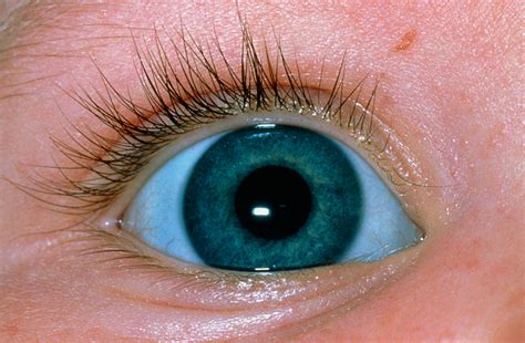 The Intensely Blue Colored Sclera Seen Here Is Most Commonly Associated