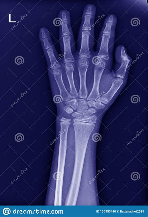 X Ray Left Wrist No Fracture And Normal Joint Stock Photo Image Of