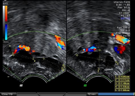 Vaginalsonografie