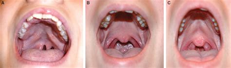 Submucous Cleft Palate Pocket Dentistry