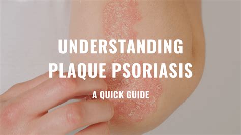 Understanding Plaque Psoriasis Hanna Sillitoe