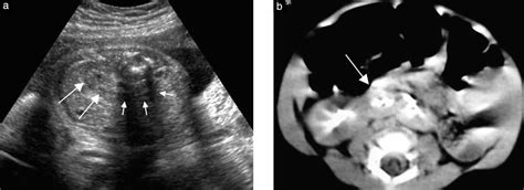 Prenatal Diagnosis Of Horseshoe Kidney By Measurement Of The Renal