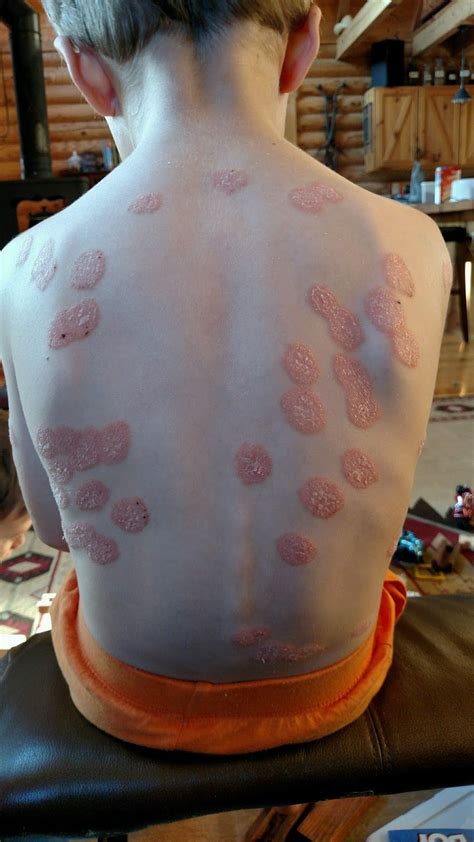 Psoriasis On Back