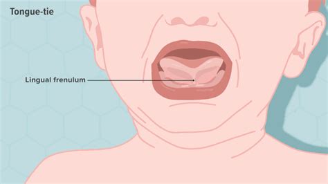 Symptoms Of Lingual Frenulum Medizzy