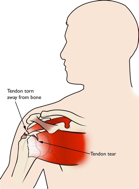 What Is A Rotator Cuff Injury And How Do You Treat It Northwest