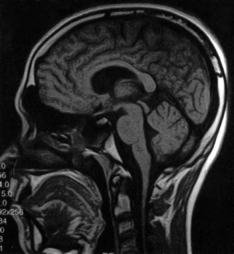 Midline Sagittal Mri Scan Shows The Brain Stem And Cerebellar Vermis