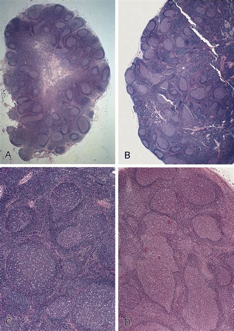 Pathology Outlines Follicular Hyperplasia