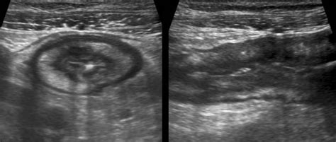 The Radiology Assistant Crohns Disease Role Of Ultrasound