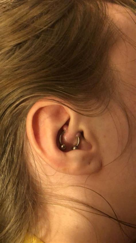 anyone have any experience with keloids forming from cartilage piercing i got my piercing done