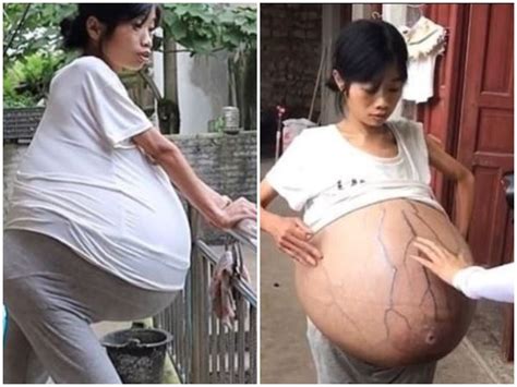 A Womans Stomach Mysteriously Increased To 19 Kg In China बीमारी के