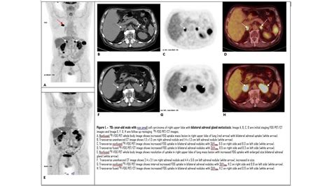 18f Fdg Petct Characterization Of Adrenal Lesions And Its