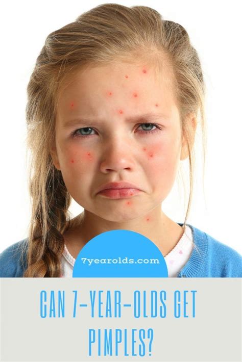 Can 7 Year Olds Get Pimples Pimples How To Clear Pimples Things To