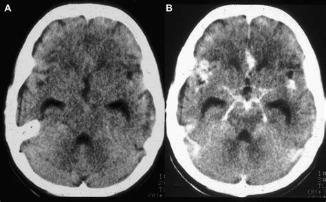 Imaging Of Meningitis And Ventriculitis Neuroimaging Clinics