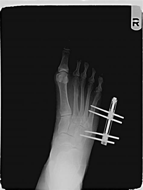 External Fixator The Foot And Ankle Online Journal