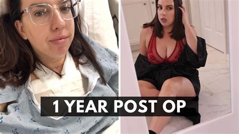 Breast Reduction Year Update Scars Cost Insurance Before After