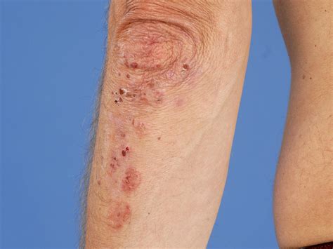 Dermatitis Herpetiformis Patientenfolder The Best Porn Website