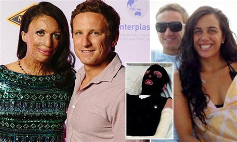 Burns Survivor Turia Pitt And Boyfriend Michael Hoskin Are Engaged Burn Survivor Survivor