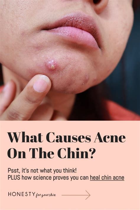 What Causes Acne On The Chin Plus What To Do About It