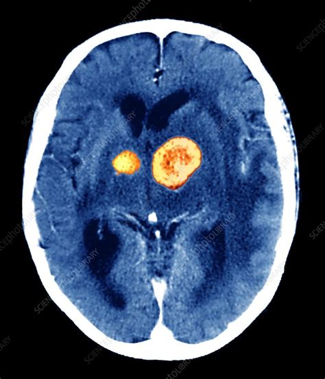 Brain Cancer Ct Scan Stock Image M1340467 Science Photo Library