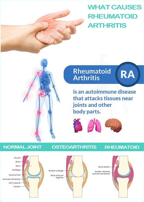 What Causes Rheumatoid Arthritis Symptoms And Treatment