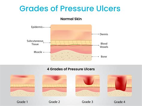 What Are The 4 Main Types Of Pressure Ulcer The EPUAP Pressure Ulcer