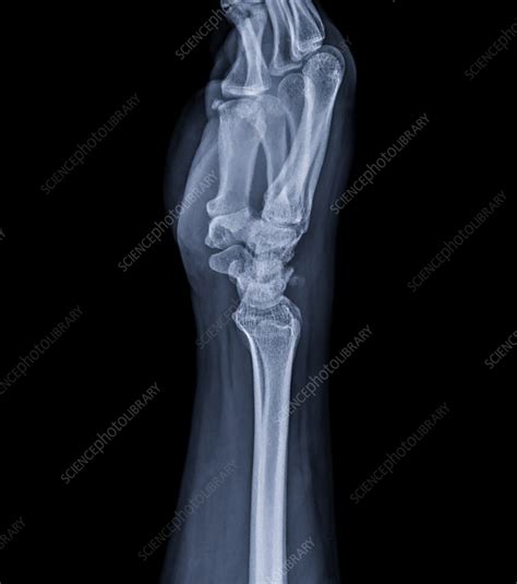 Healthy Wrist X Ray Stock Image F0375162 Science Photo Library