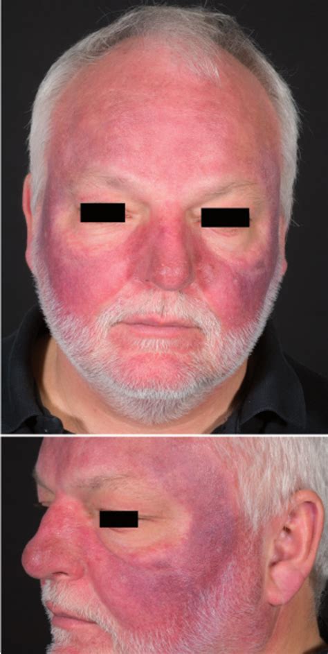 Clinical Appearance Of The Hyperpigmentation In The Face Notice The