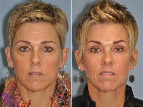 Blepharoplasty Photos Chevy Chase Md Patient 13041