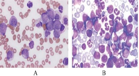 A Peripheral Blood Smear Of Cml Accelerated Phase Showing
