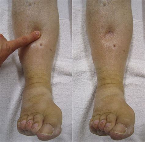 What Is The Difference Between Edema And Lymphedema Compare The