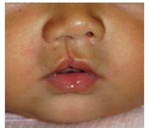 Orofacial Clefts Cdc