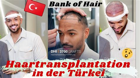 Meine Haartransplantation in der Türkei darauf solltet ihr achten