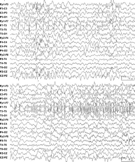 Ictal Eeg Of A Typical Seizure In Self Limited Epilepsy With