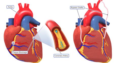 Bypass Surgery And Angioplasty Niceheartdoctor