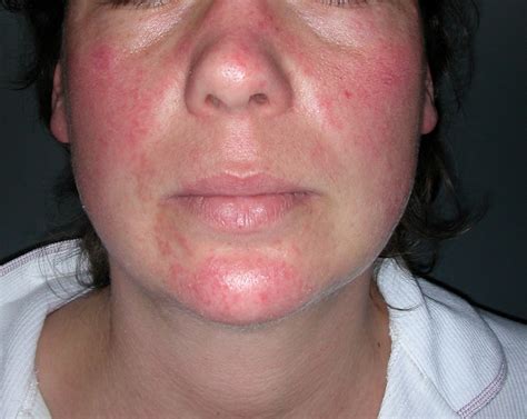 Skin Manifestations Of Thyroid Disorders A Review Dermatology Advisor