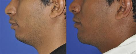 Chin Augmentation Neck Liposuction Mehta Plastic Surgery