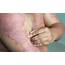 Biologics Make Psoriasis Clearance A Real Possibility  Dermatology