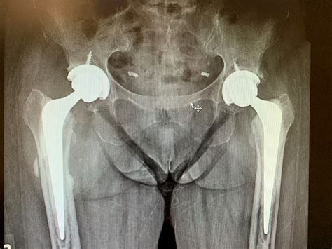 Case Study Bilateral Hip Replacement In 66 Year Old Female