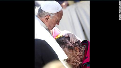 Pope Francis Embrace Of A Severely Disfigured Man Touches World