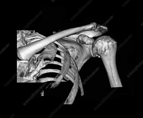 3d Ct Of The Shoulder Stock Image M1100654 Science Photo Library