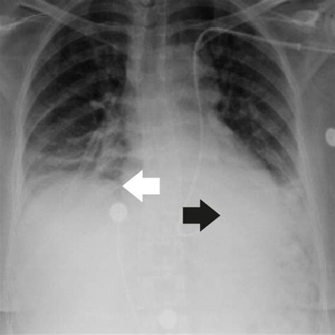 Radiographic Control After New Placement Of Transvenous Pacemaker