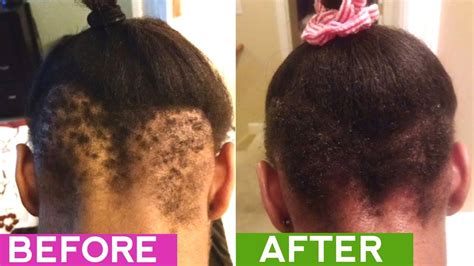 How To Regrow Hair Naturally Alopecia And Bald Spots Thick Hair