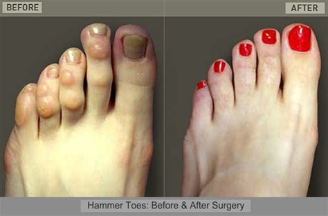 About Hammer Toe Health And Medical Information