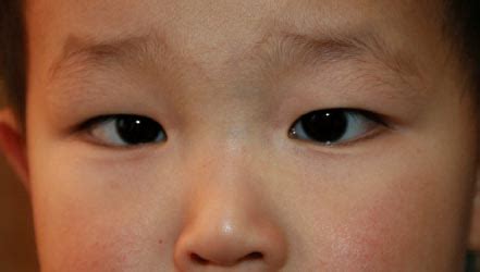 Epicanthal folds are normal in asians like in native americans and in korean population. Flat Nasal Bridge And Epicanthal Folds - Facial Features Of Proband Newborn Note Broad Forehead ...