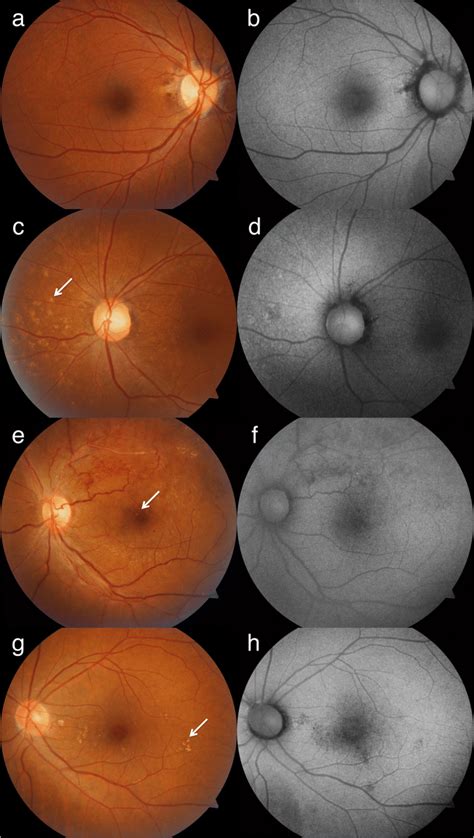 Color Fundus Photography And Fundus Autofluorescence Faf Images Of