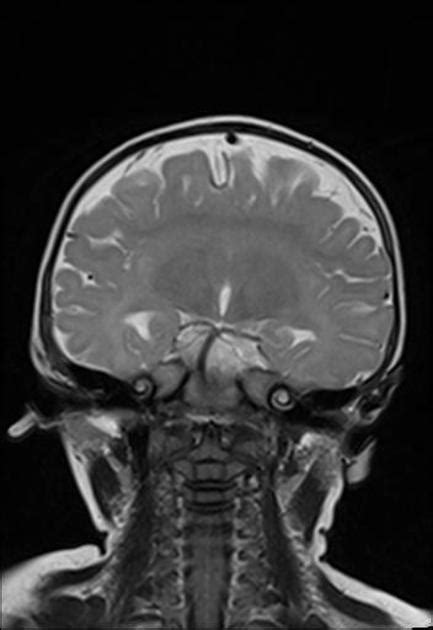 Semilobar Holoprosencephaly Radiology Case