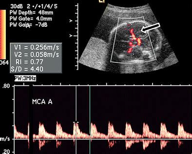 Middle Cerebral Artery Normal Spectrum Is Recorded From The Middle
